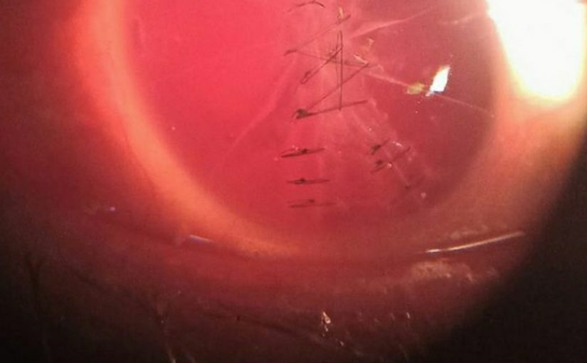 В Новороссийске, чтобы спасти зрение пациенту, на глазное яблоко наложили 20 швов самыми тонкими нитями
